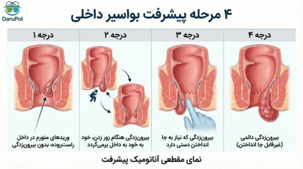 انواع بواسیر داخلی
