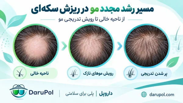 نمایش مسیر رویش مجدد مو ها بعد از درمان ریزش سکه ای مو.